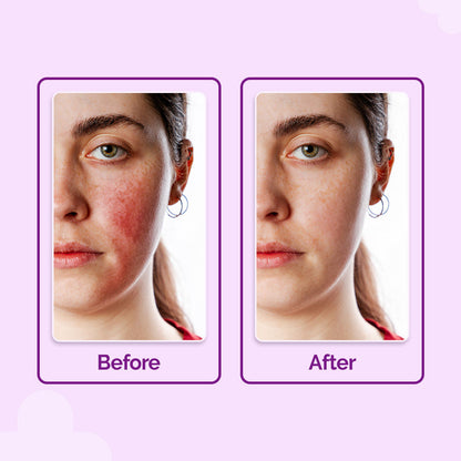 The Derma Co Hypochlorous Anti-Acne Hydrating Spray (200ml) - Calms Breakouts & Redness
