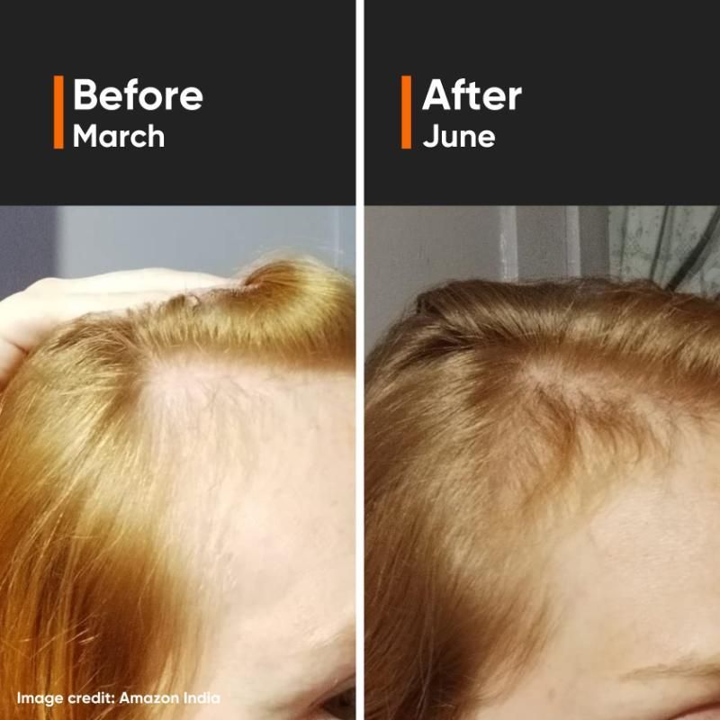 Minimalist Hair Growth Actives 18% Hair Serum - Boost Growth (30ml)